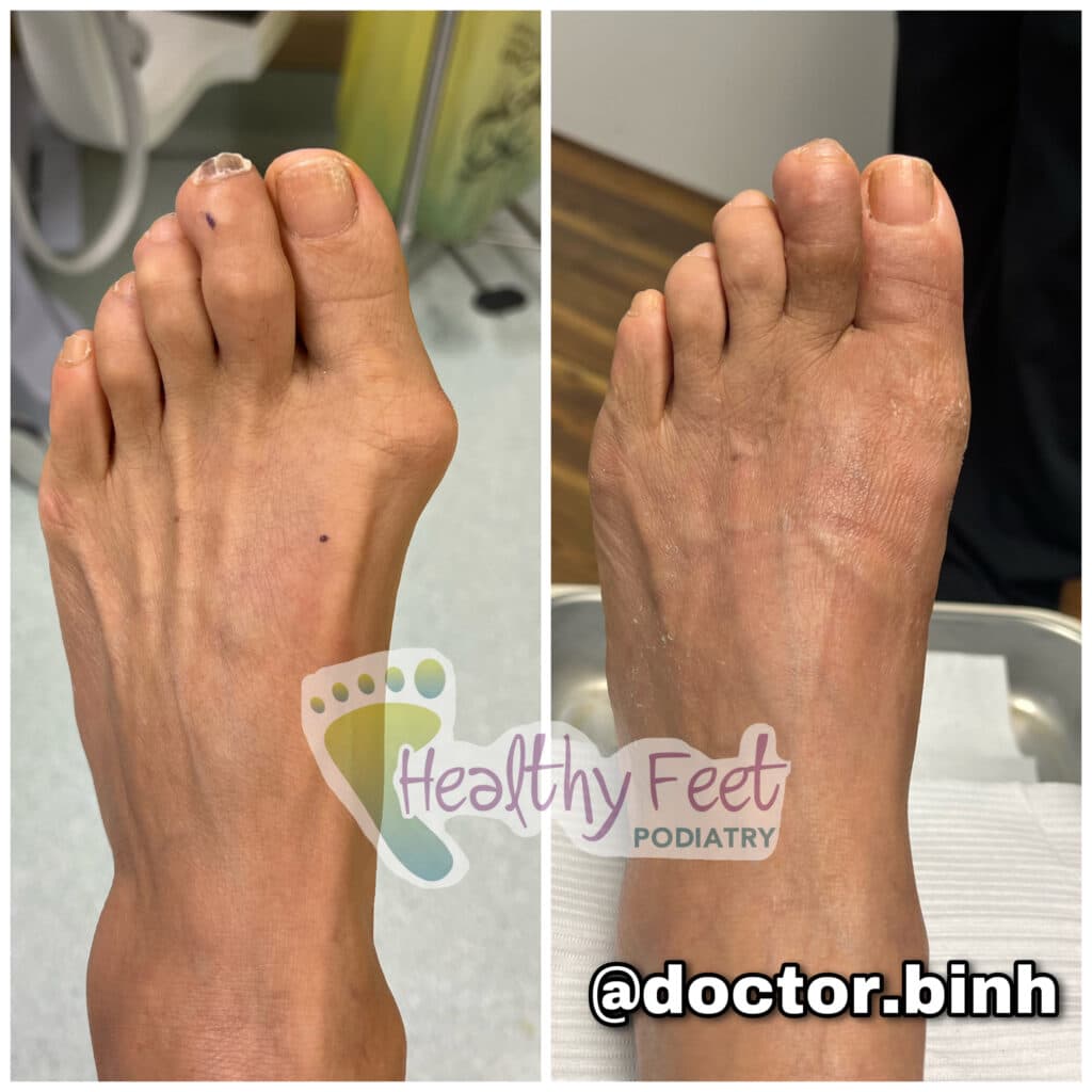 Minimally Invasive Bunion Surgery Wesley Chapel Fl