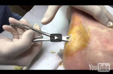 14. Wart Removal Surgery