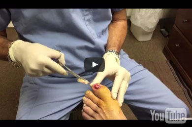 16. Lifted toenail injury removal 1