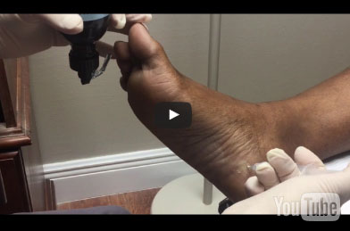 18. Heel Pain Treatment With Cortisone Shot