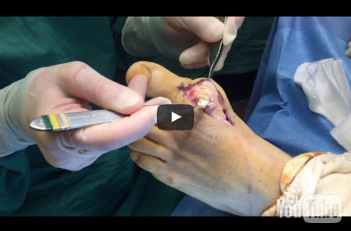 19. Gout Surgery of the Foot – Removing Gout Crystals Pt. 1