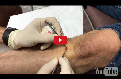 23. Removal of a Cyst From a Leg