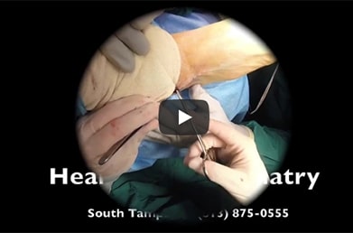 Healthy Feet Podiatry Bunionectomy Video Cover
