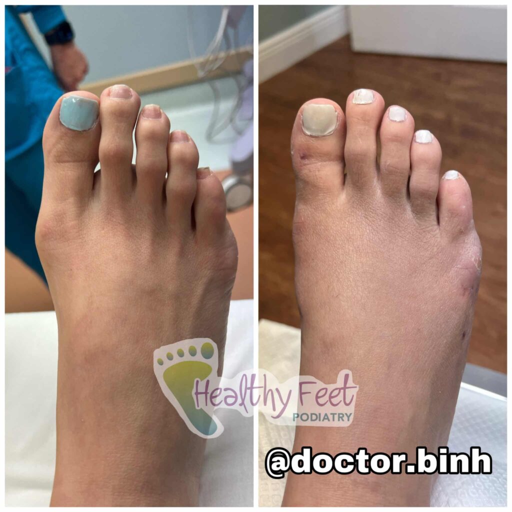 Bunion SouthtampaMIS