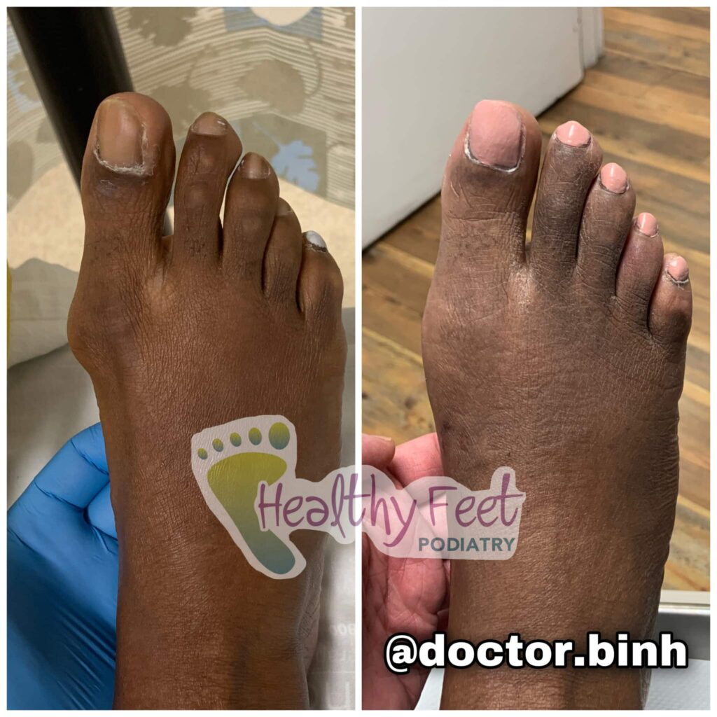 Bunion Surgery