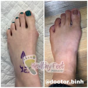 Bunion Transformation