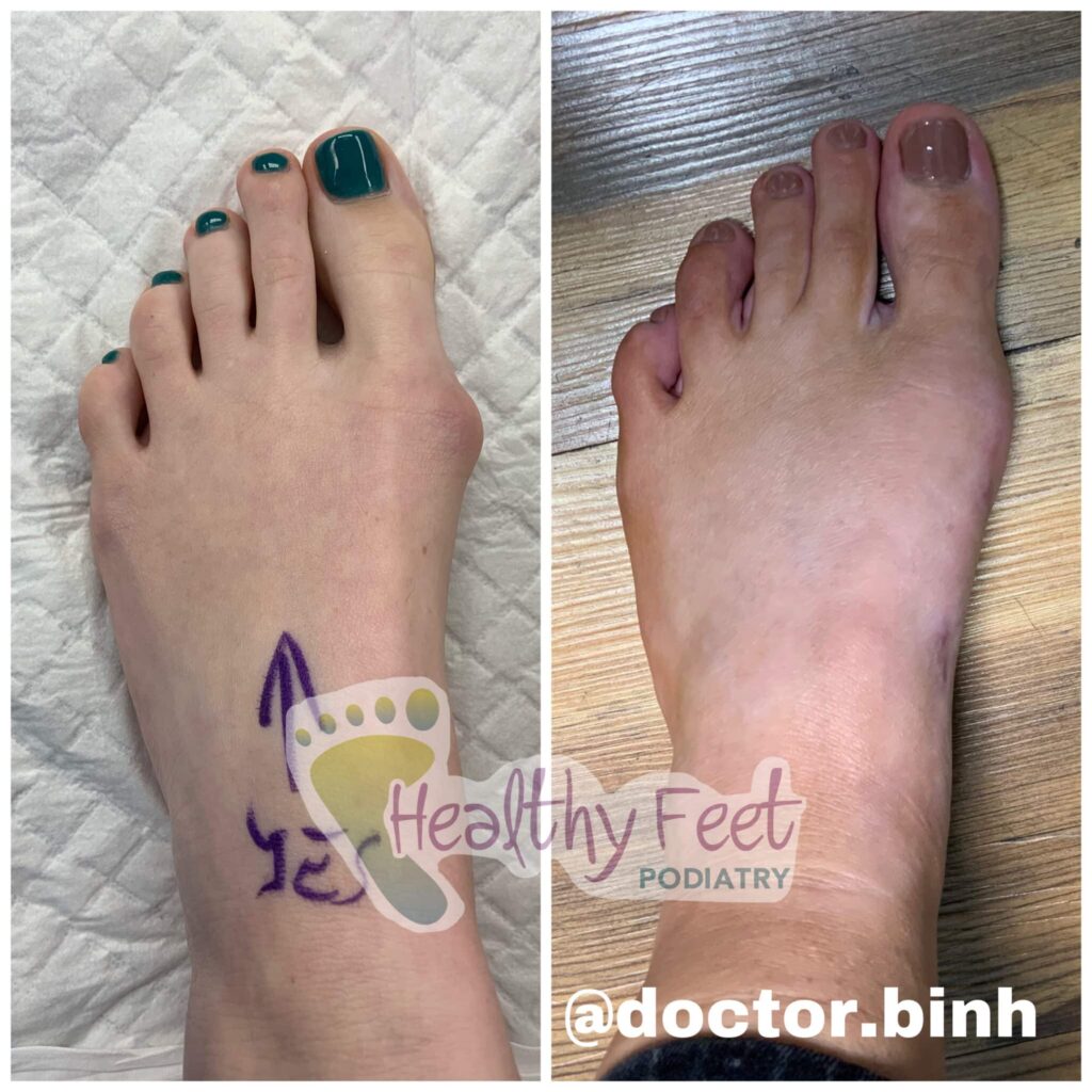 Bunion Transformation