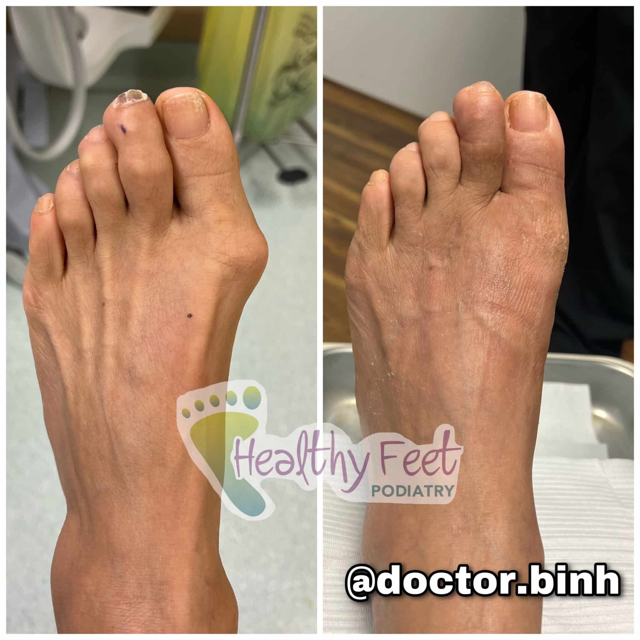 Minimally Invasive Bunion Surgery Wesley Chapel FL