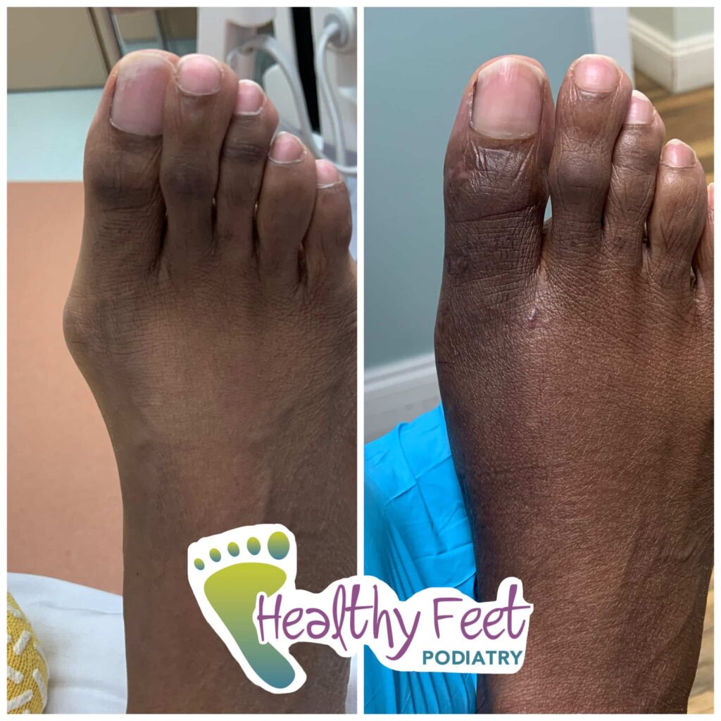 Minimal Incision Bunion