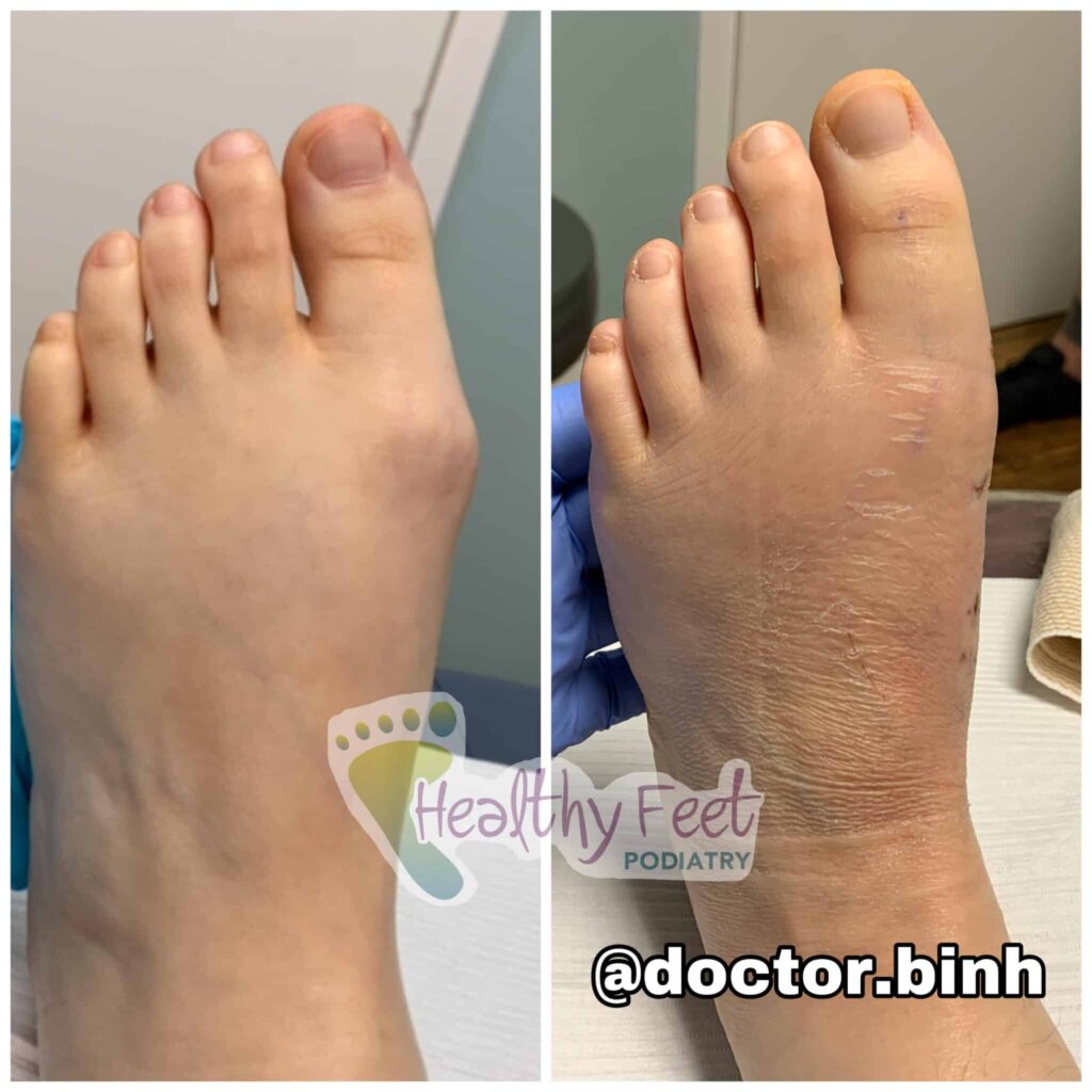 Minimally Invasive Bunion Incision