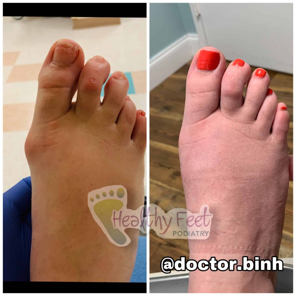 Minimally Invasive Bunion Surgery