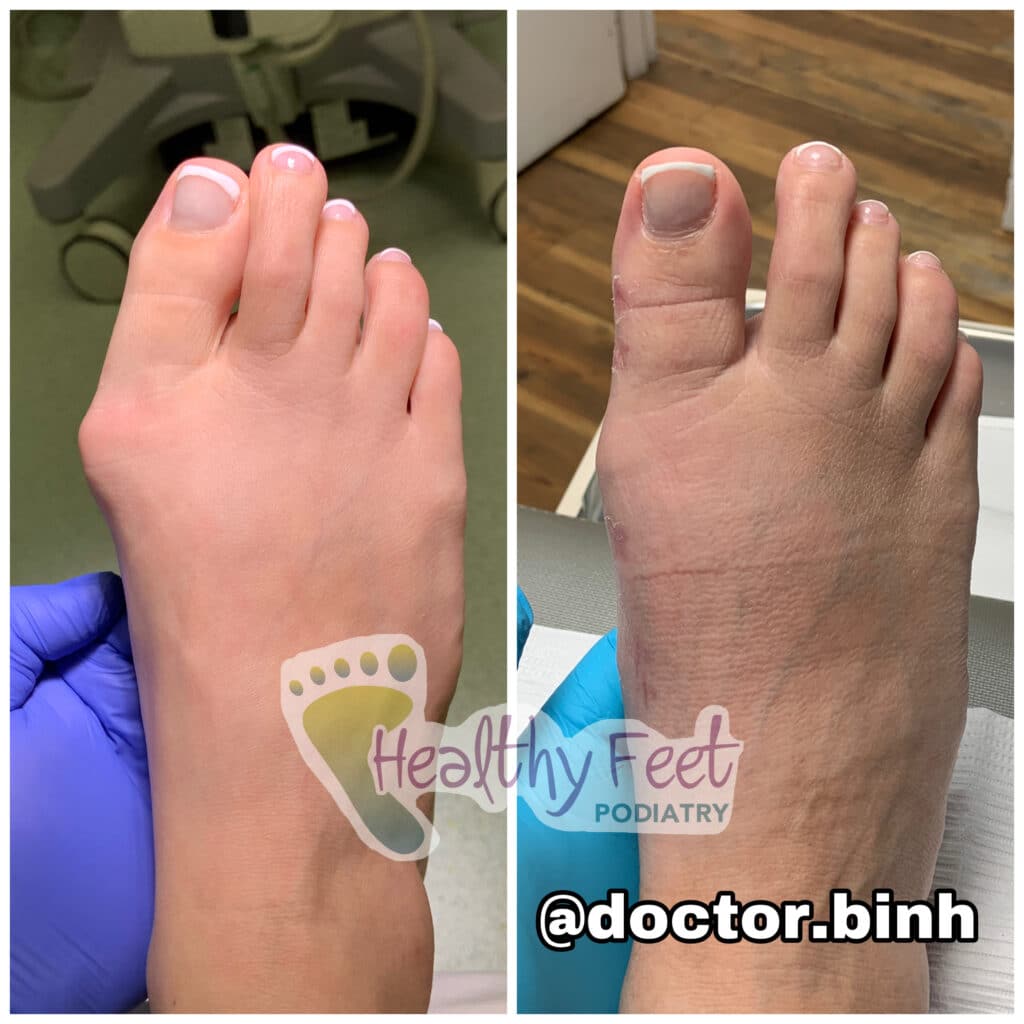 Minimally Invasive Bunion Surgery Healthy Feet Podiatry