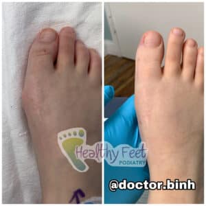 NO SCAR Bunion (1)
